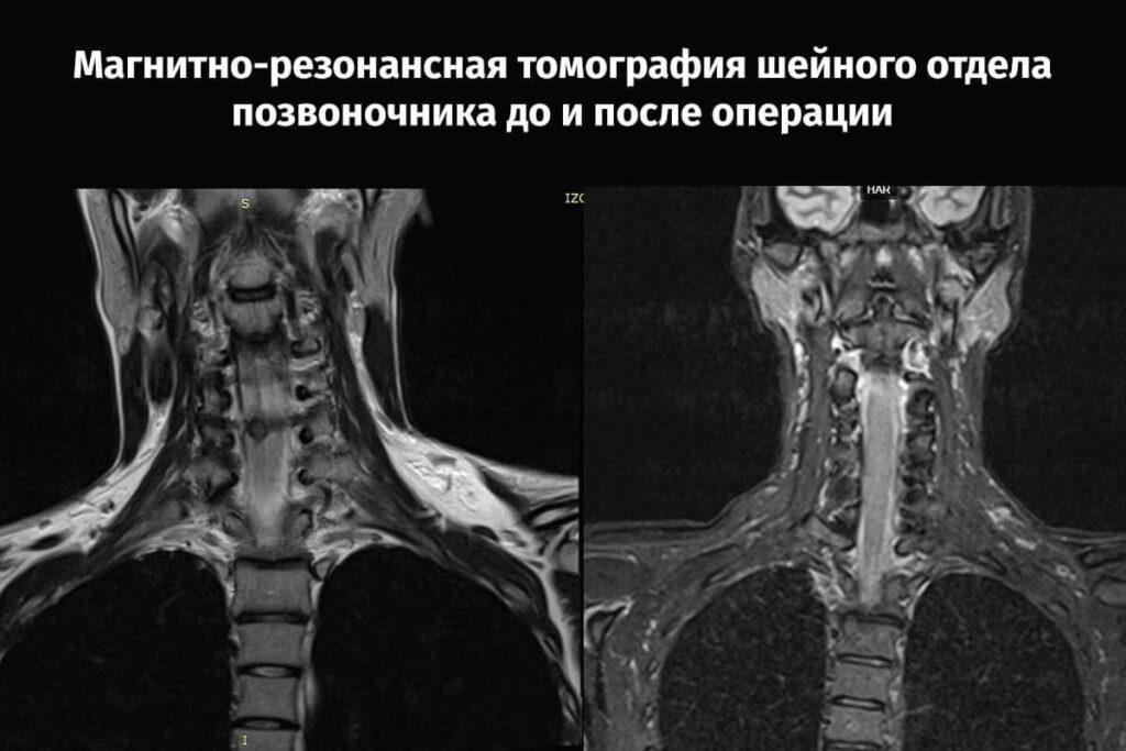 операция на позвоночнике