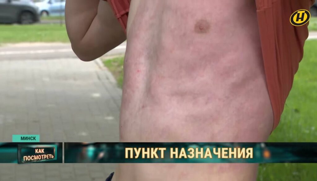 Опасный тренд: подросток-зацепер получил 50% ожогов после повтора трюка из TikTok