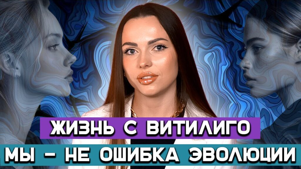 «Теперь я — панда»: реальная жизнь с витилиго без прикрас