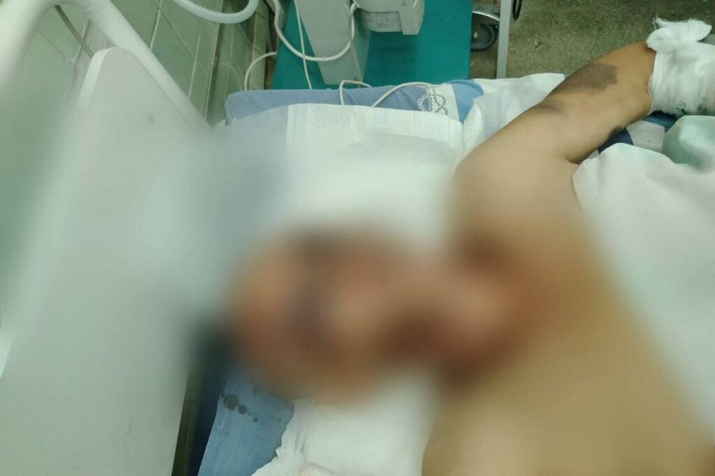 10 ударов и гематома мозга: женщина в Слуцком районе скрывала побои, пока не попала в реанимацию