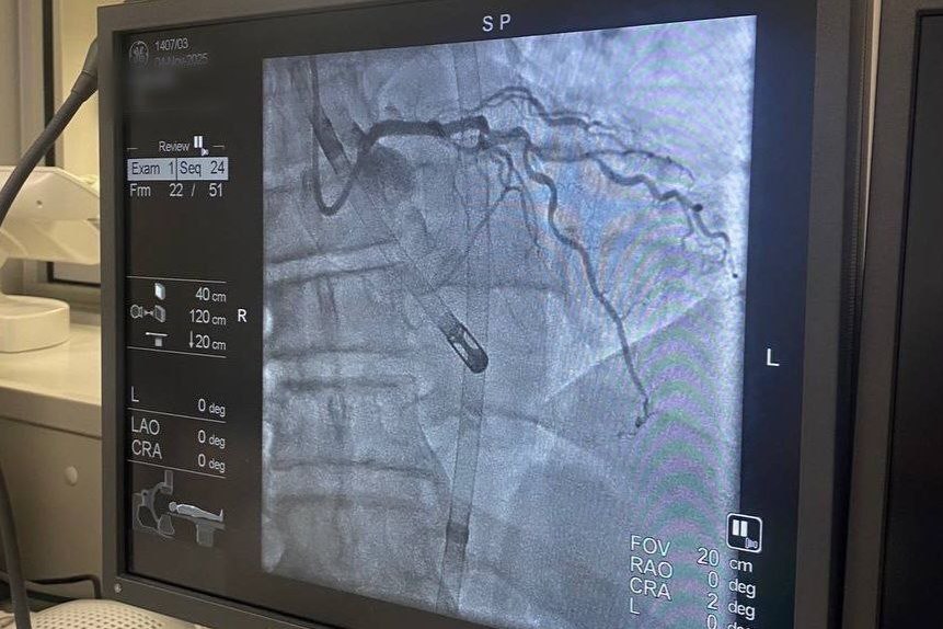 В Гомеле провели уникальную операцию и спасли пациента с инфарктом